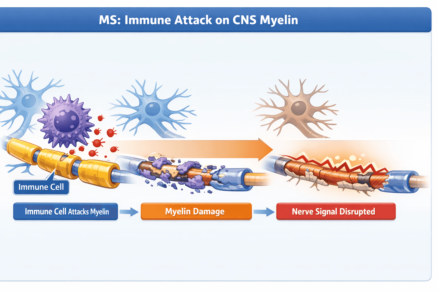 Multiple sclerosis involves immune system attacks on CNS myelin, leading to neural damage.